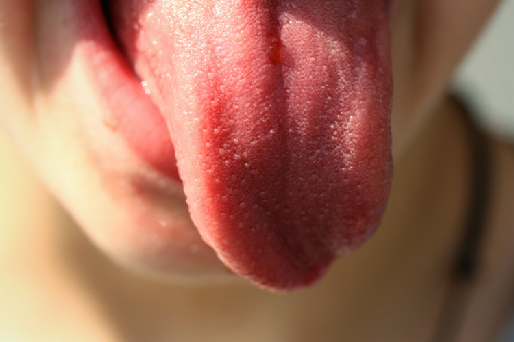 Лечение ожога языка